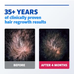 Rogaine Men's Extra Strength 5% Minoxidil Solution 3 Mo Supply, 3x 2 Fl Oz - Görsel 3