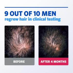 Rogaine Men's Rogaine 5% Minoxidil Foam for Hair Regrowth Topical Hair Loss Treatment for Men to Regrow Fuller Thicker Hair Unscented Minoxidil Topical Aerosol - Görsel 3