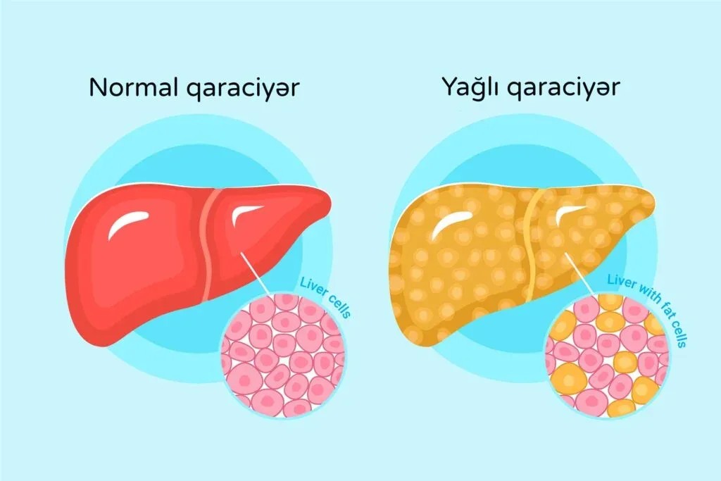Karaciğer Yağlanması (fatty Liver) Olan Ağır Siklet Sporcularda Kolin Kullanımının Önemi