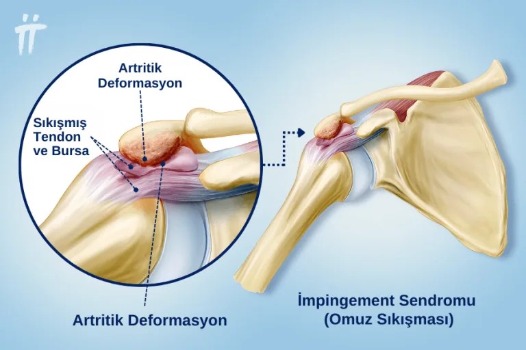 omuz-sikismasi-msm-takviyesi_1792003088_32026826