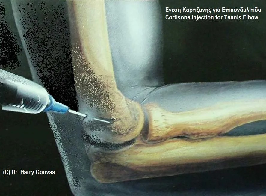 Tenisçi Dirseği ve Tendon İltihaplanmasına (tendonitis) İyi Gelen Takviyeler 2 Tenisçi Dirseği ve Tendon İltihaplanmasına (tendonitis) İyi Gelen Takviyeler